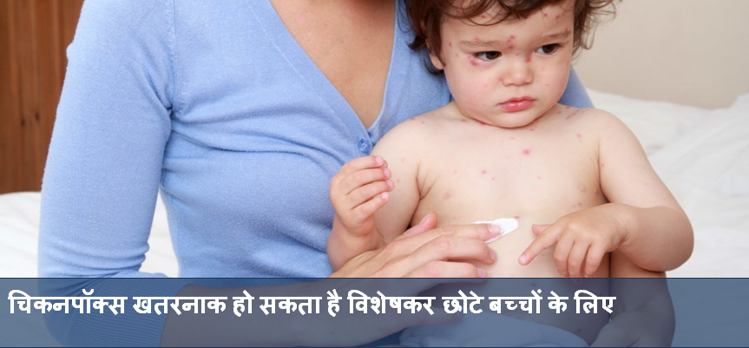 chickenpox vaccination is must for small children